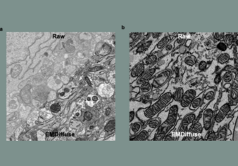 Inactivation of a DNA repair gene called FANCM enhances the formation of DNA damage and chromosomal instability induced by a PARP inhibitor, leading to massive cancer cell death. Image modified from Liu et al, Cell Reports (2024).