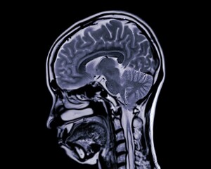 MRI